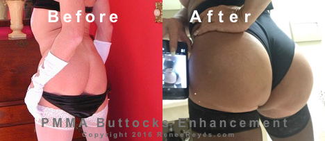 PMMA Injections Before After Photos